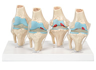 膝關節(jié)健康病態(tài)比較模型 4階段膝關節(jié)病變模型